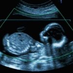 Smiling Fetus? Scientists Pump Brakes Fetal ultrasound scan image